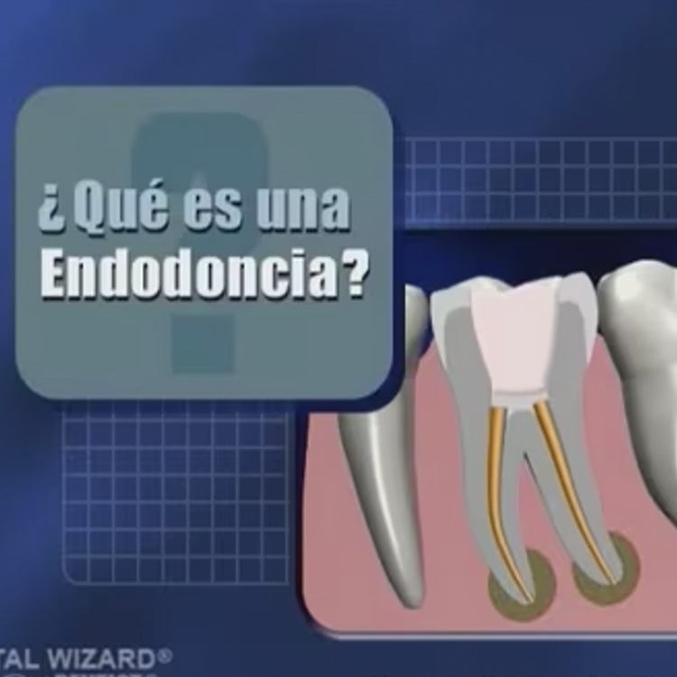 What is Endodontics? (Spanish)