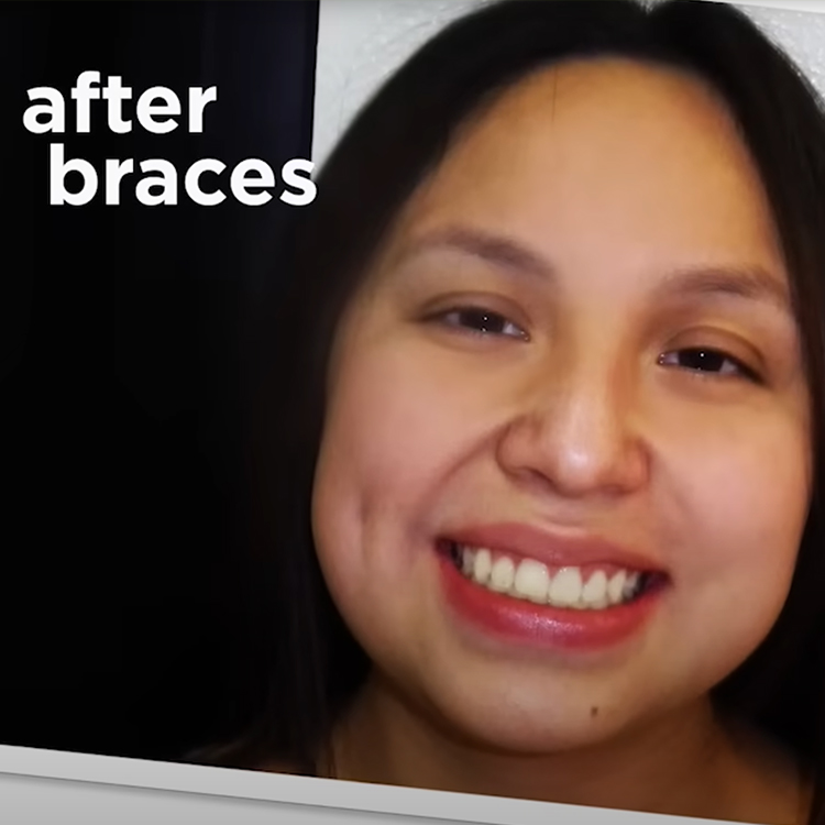 Video: What are the Real Health Benefits of Braces?