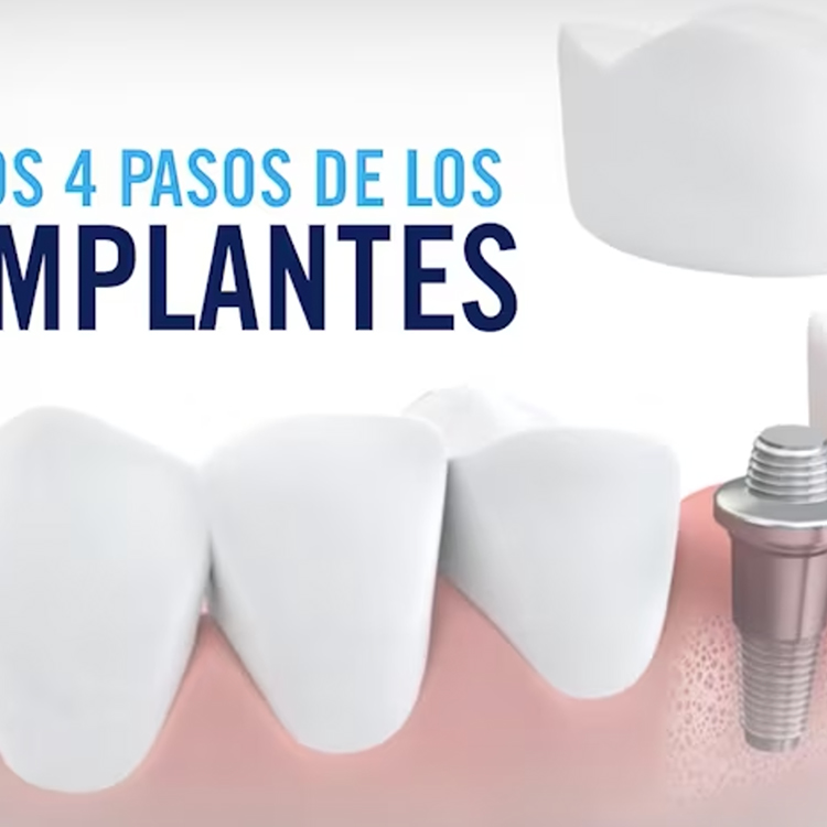 4 Steps to Implants (Spanish)