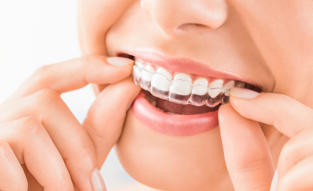 Image of smiling person with clear braces or aligner